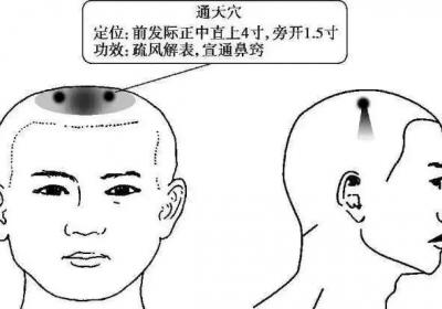 足太阳膀胱经经穴：通天穴