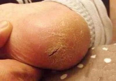 秋冬脚后跟干裂，小腿长”鱼鳞”，如何通过艾灸来调理？