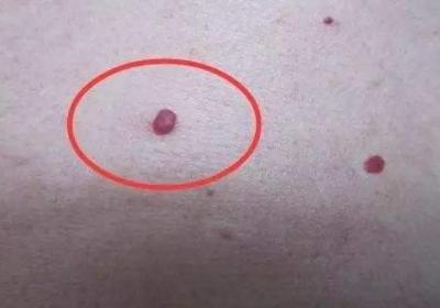 血痣是怎么回事？不同颜色的痣成因各异