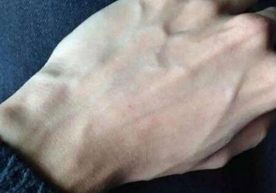 不同部位出现青筋对应不同症状，如何改善身体这种状况呢？女性朋友一定要看看