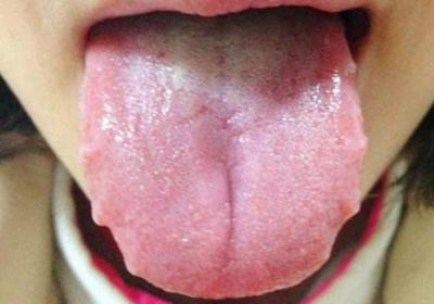 舌头上有齿痕是什么问题？齿痕舌要如何调理呢？