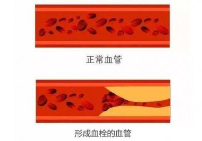 血栓对人体有哪些危害？血栓堵在不同部位对健康的影响
