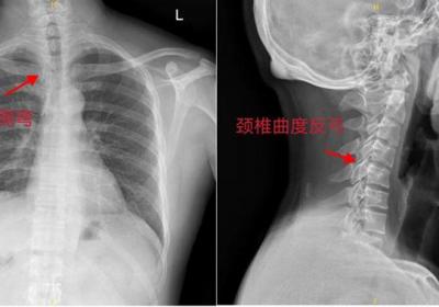 胸口痛是心脏病？不一定！中医正骨妙解这样的“胸口痛”
