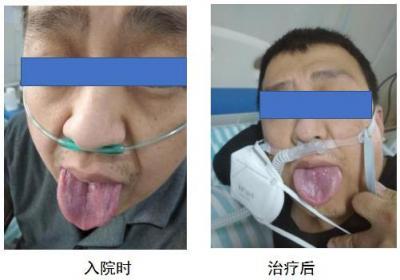 “针药”显奇效，广东医生针药并用，隔离病区重症新冠患者转危为安