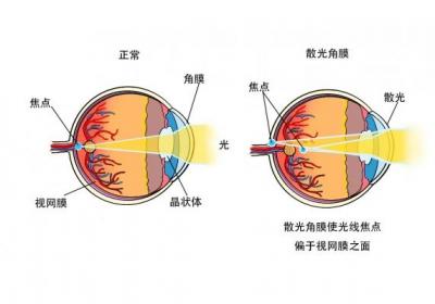 散光是什么意思