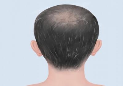 白头发比别人多可能缺乏哪3种营养