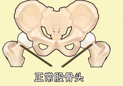 股骨头位置在哪里