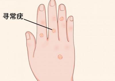 hpv靠什么传播