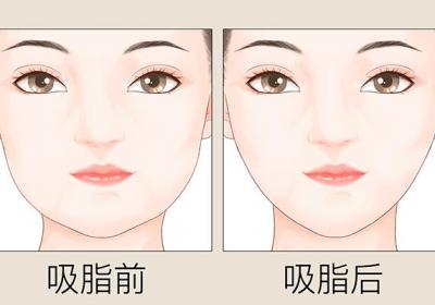 治疗吸脂哪家医院好