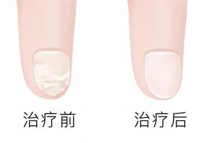 治疗灰指甲哪家医院好