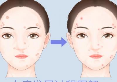 水痘的传播途径