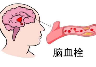 血栓的症状是什么