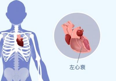 冠心病的症状表现在哪些方面