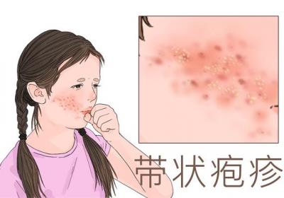 带状疱疹传播途径