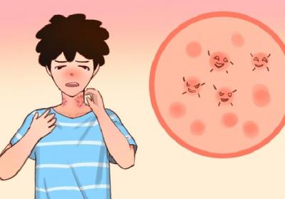 湿疹怎么治疗能去根