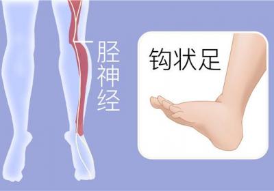 上运动神经元损伤表现