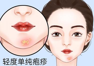 疱疹的症状和治疗