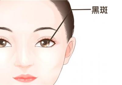 什么是黑斑病?