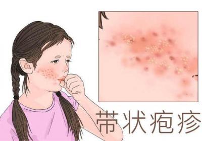 疱疹性咽颊炎症状