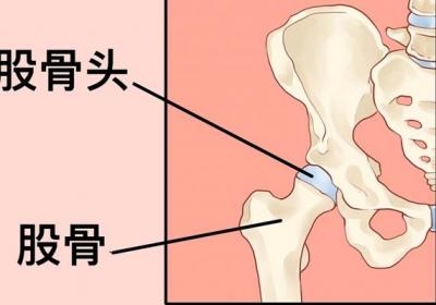 股骨干上13段骨折怎么办