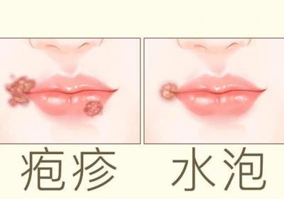 上火嘴唇起泡怎么办，怎么快速消除