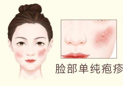 疱疹是什么原因引起的
