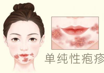 疱疹会传染吗
