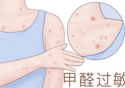 贴三伏贴后皮肤红肿怎么回事