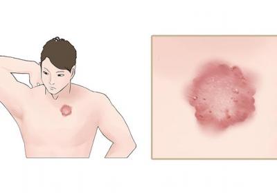 热疮用什么药