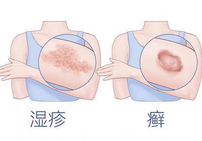 血热证牛皮癣的中药治疗方法是什么
