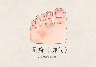 脚底板长水泡很痒是怎么回事