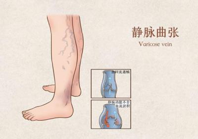静脉曲张怎么预防