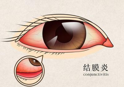 眼屎多怎么办