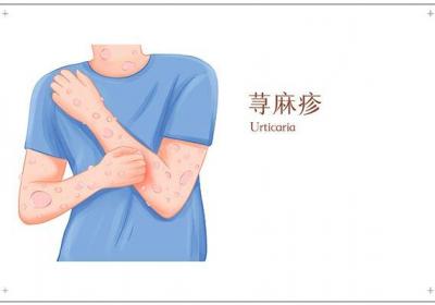 荨麻疹消退方法
