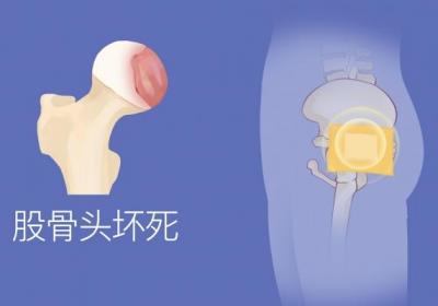 股骨头在哪个位置