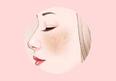 黄褐斑的刺络拔罐方您什么了解呢 黄褐斑刺血拔罐