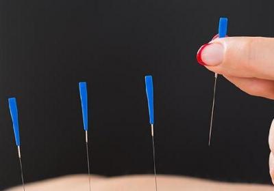 针灸做几次能打通经络