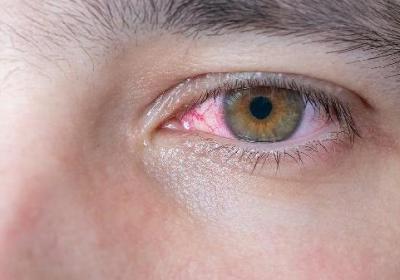 针灸治疗眼睑痉挛的优势有哪些 针灸治疗眼部痉挛