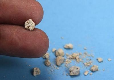 双肾泥沙样结石严重吗
