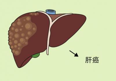 曙光医院李琦经验分享：肝癌治疗发展现状如何