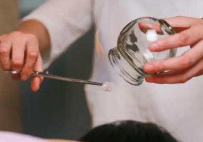 痰热扰心型失眠的拔罐疗法