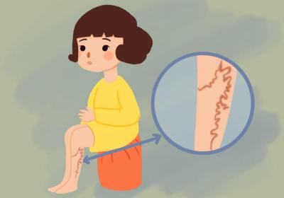 静脉曲张的原因是什么？这3个原因要注意