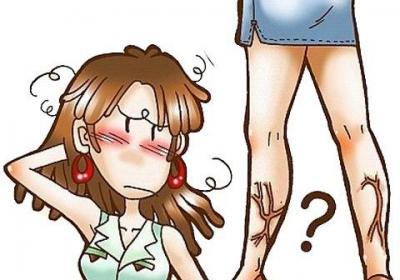 静脉曲张的症状有哪些？哪些代表了静脉曲张？