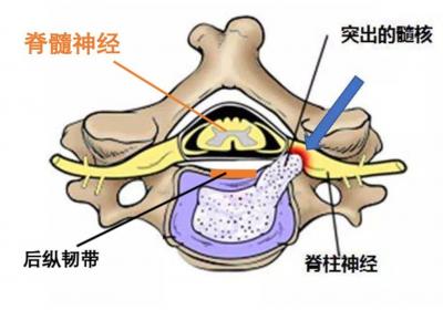 脊髓型颈椎病的中医疗法