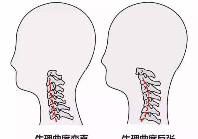 你的颈椎生病了吗？颈椎也是有自愈能力的！