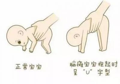 小宝宝脑瘫早期的表现症状