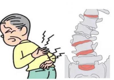 腰椎间盘突出症怎么引起的？