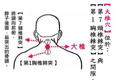 喉咙疼之拔罐疗法