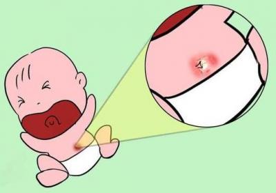 新生儿肚脐发炎、不脱落
