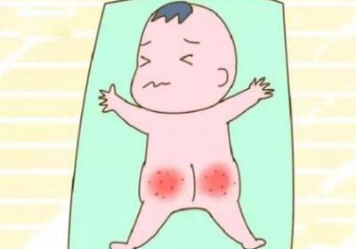 婴幼儿臀部护理不当会发生什么